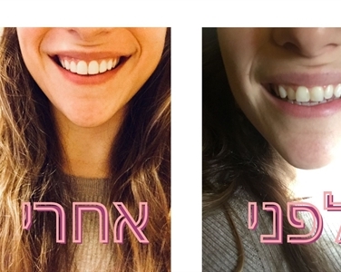 יישור שיניים בירושלים