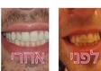 יישור שיניים בירושלים